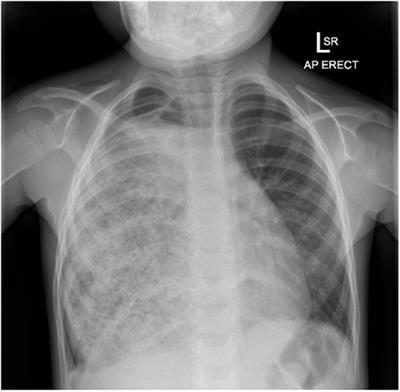 Giant Gastric Bezoar Complicating Congenital Esophageal Atresia Repaired by Gastric Interposition—A Case Report